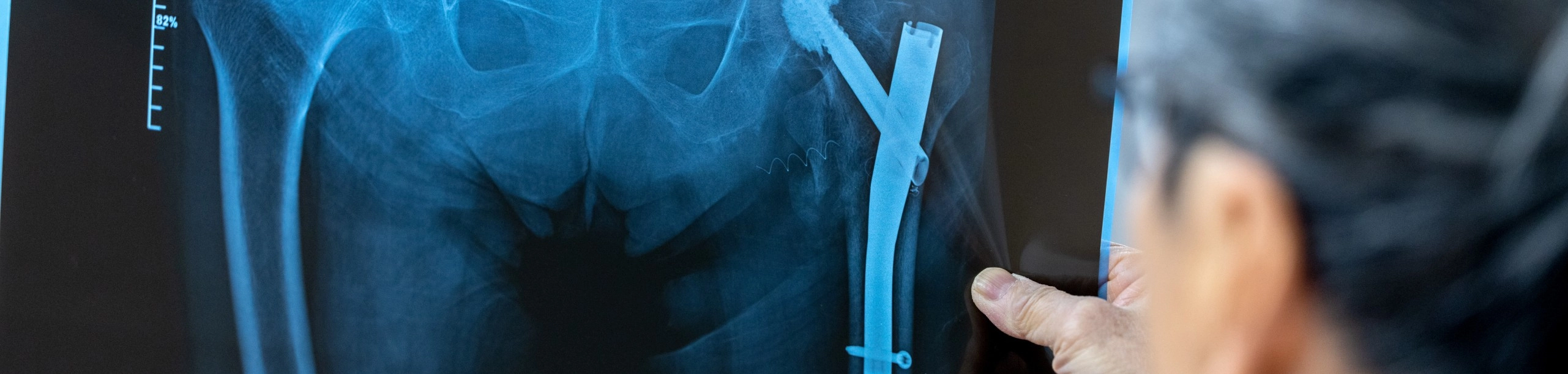 Prothèses articulaires | Clinalliance SMR SSR | Île-de-France